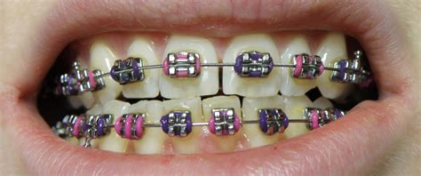 Medfriendly Medical Blog Does Your Child Need Braces 3 Ways To Find Out