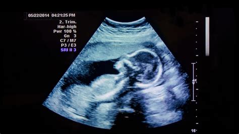 How To Read An Ultrasound A Guide To Understanding Ultrasound Images