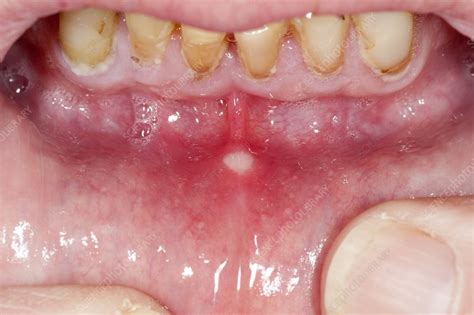 aphthous ulcer in the mouth stock image c013 0869 science photo library