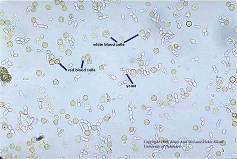 Red And White Blood Cells And Yeast In Urine Sediment Medical