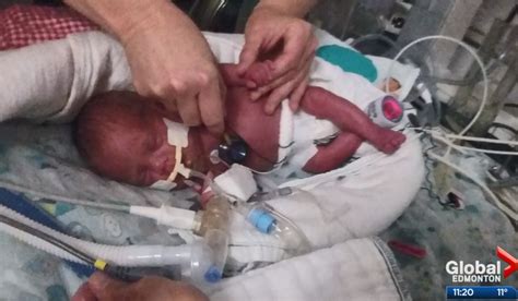 Premature Baby Born At 24 Weeks Weighed Just 1 Pound But Now Hes