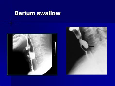 Risks Of Barium Swallow The Request Could Not Be Satisfied