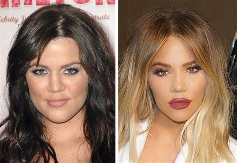 Celebrities Before Plastic Surgery 10 Pics Sharepics