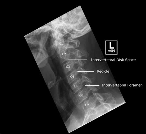 Cervical Spine Radiographic Anatomy Wikiradiography