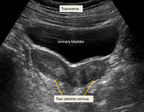 Figure Transabdominal Ultrasound Of Uterine Didelphys