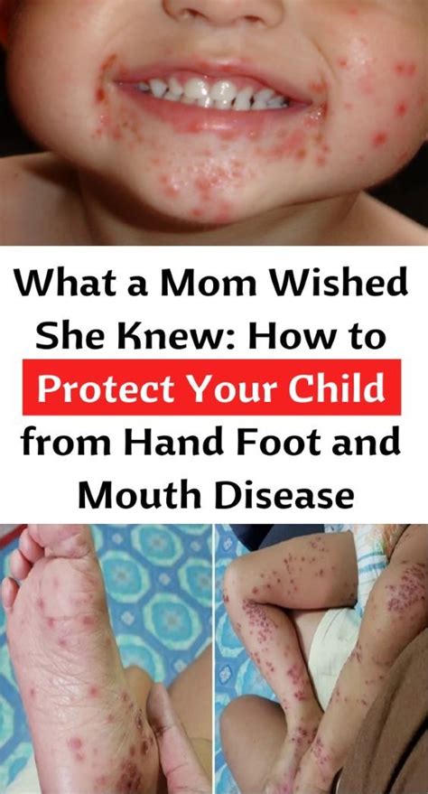 What A Mom Wished She Knew How To Protect Your Child From Hand Foot