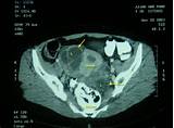 This article discusses how to recognize and diagnose different types of ovarian cystic lesions, including an approach to management. CT scan showing multiple septated cystic lesions in both ...
