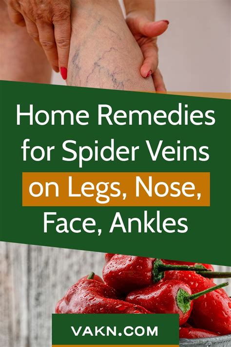 Home Remedies For Spider Veins Natural Herbal Removal Of Spider