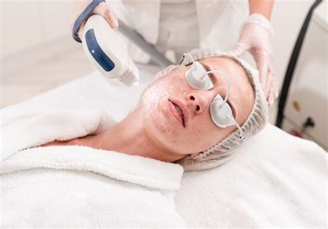 Acne Treatment Faqs Hrh Laser Hair Treatments