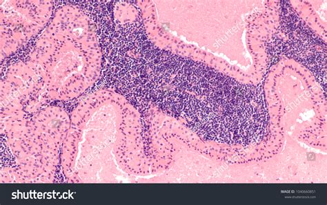 Microscopic Image Showing Histology Pathology Warthins Stock Photo
