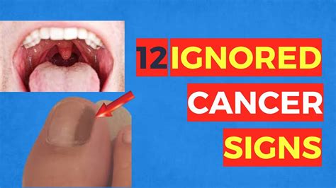 12 Ignored Cancer Signs Youtube