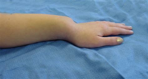 Madelungs Deformity Hand Surgery Source