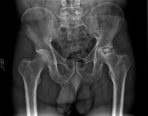 Necrosis (from the greek νεκρός, dead, νέκρωσις, death, the stage of dying, the act of killing) is the premature death of cells and living tissue. Ortho Dx: Alcoholism-Induced Avascular Necrosis of the Hip ...