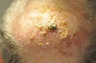 Actinic Keratoses Treatment S Weymouth MA | GK Derm