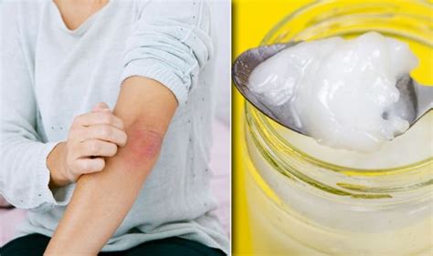 Eczema Treatment Prevent Dry And Itchy Skin At Home With Coconut Oil