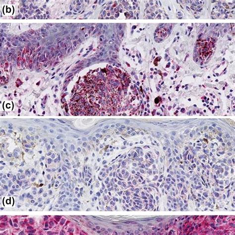 Showing Immunoreactivity In Cutaneous Melanoma For Dcd Mainly Download Scientific Diagram