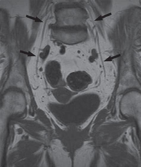 Normal Obturator Nerve Coronal T1 Image Shows The Normal Obturator