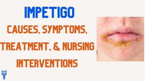 Impetigo Causes Symptoms Treatment And Nursing Interventions Youtube