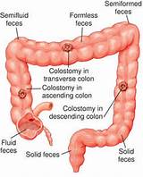 Colostomy Medical Definition Pictures