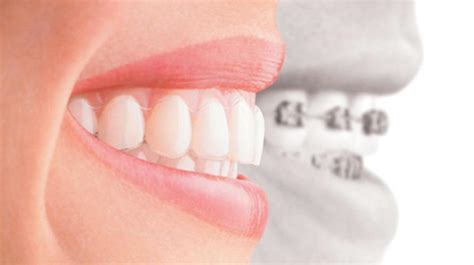 Straighten Teeth Without Braces Or Invisalign Teethwalls