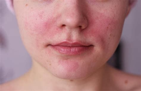 Шелушение и покраснение кожи на лице лечение Информация которая удивляет