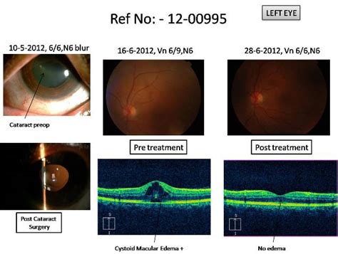 Drushtieye And Retina Center Cataract Surgery Followed By Cystoid