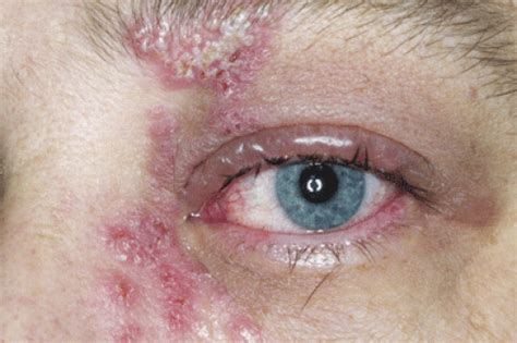 Everything You Need To Eye Shingles Early Causes And Treatments