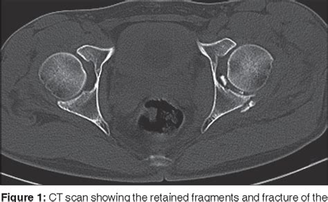 Figure 1 From Arthroscopic Removal Of Intraarticular Fragments