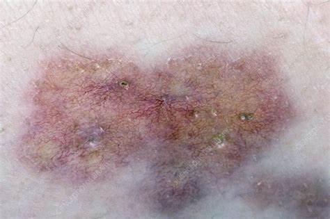 Diabetic Skin Lesion Stock Image C0037231 Science Photo Library