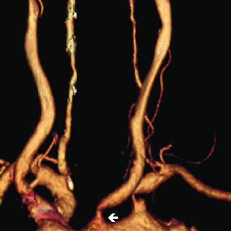 CTA Showed Occlusion Of The Right Internal Carotid Artery And Stenosis