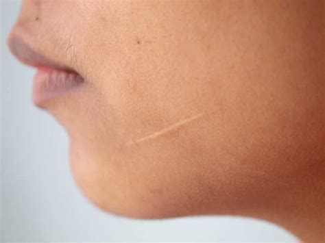 Skin Cancer On Scar Tissue