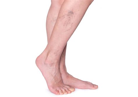 Varicose Vein Info And Treatment The Vein Institute At Ssa