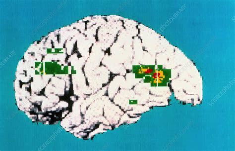 Coloured Pet Scan Of Brain Showing Depression Stock