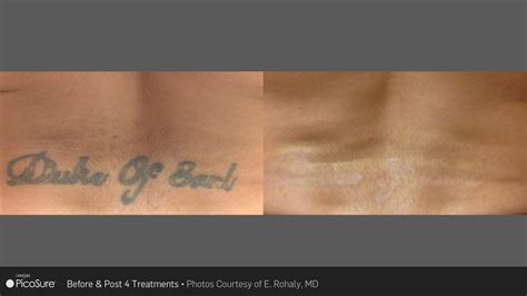 Laser Ink Picosure Laser Tattoo Removal Specialists Bedford New