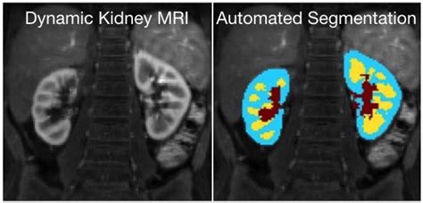 Automatic Renal Segmentation For Mr Urography Using 3d Grabcut And