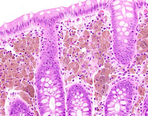 Pathology Outlines Melanosis Coli