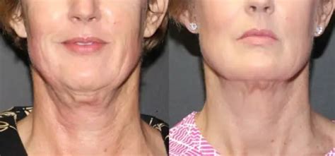 Sagging Neck Skin Exercises Solutions Surgery Home Remedies Turkey