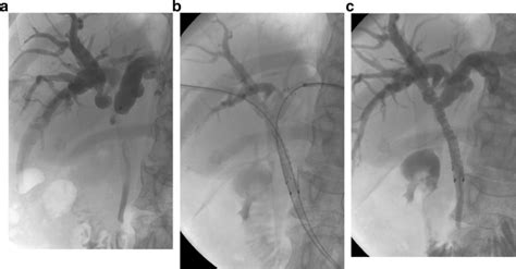 Percutaneous Stent Placement For Malignant Hilar Biliary Obstruction