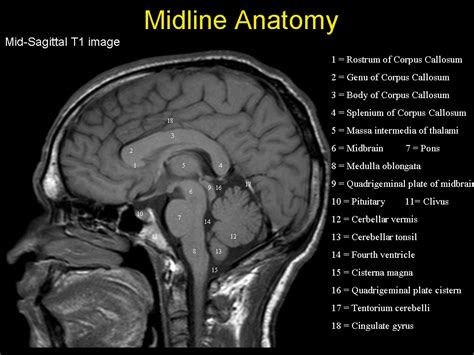 40 Midline Sagittal Brain Anatomy Mri