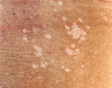 Durch zu häufiges waschen entsteht: Pityriasis versicolor