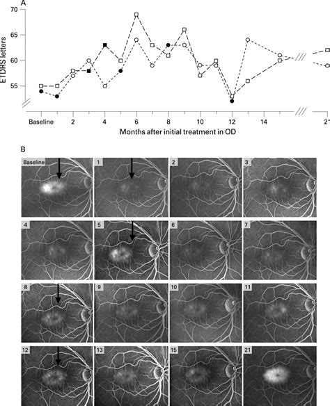 Eighteen Month Follow Up Of Intravitreal Bevacizumab In Type 2