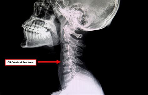 Dislocated Neck X Ray