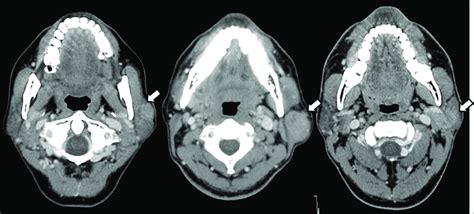 Contrast Enhanced Ct Images Of Parotid Gland Tumors Arrows In Three