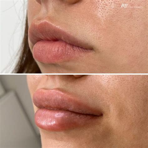 lip fillers starting from £ 99 m1 med beauty london liverpool