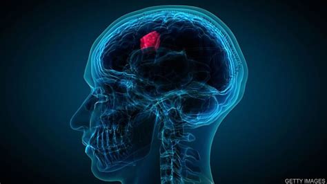 New Hope For Brain Cancer Patients 脑肿瘤患者的新希望 Bbc英语大破解 英语学习站爱词霸