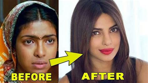 Priyanka Chopra Plastic Surgical Procedure Photographs Before And After Priyanka Chopra