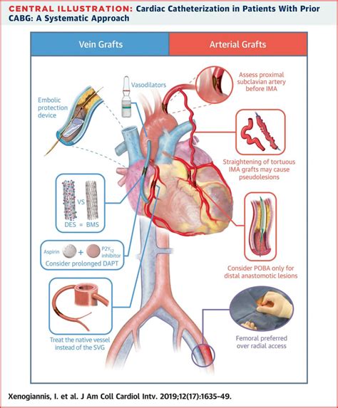 Update On Cardiac Catheterization In Cardiac Catheterization