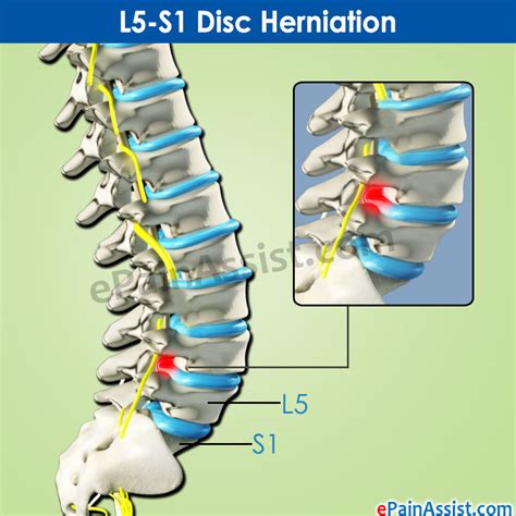 L5 S1 Disc Herniation What Is The Treatment And Recovery Period