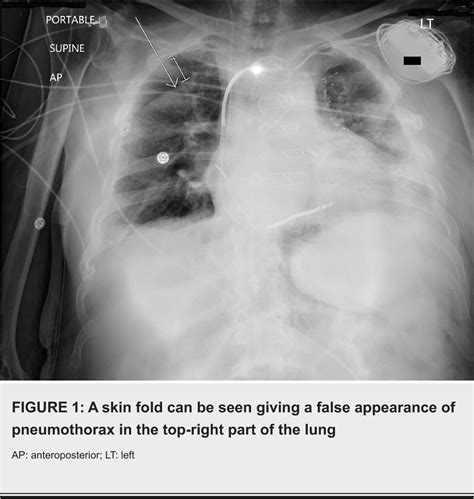 Figure 1 From A Case Of Pseudo Pneumothorax With Complications