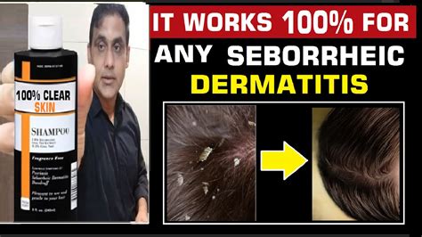 5 Most Effective Lotion To Treat Seborrheic Dermatitis सेबोरहाइक